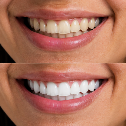 LUMI SMILE (tiras blanqueadoras dentales)